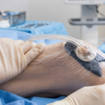 Apósito hidrocoloide para heridas quirúrgicas