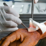 Heridas infectadas: señales que requieren atención inmediata